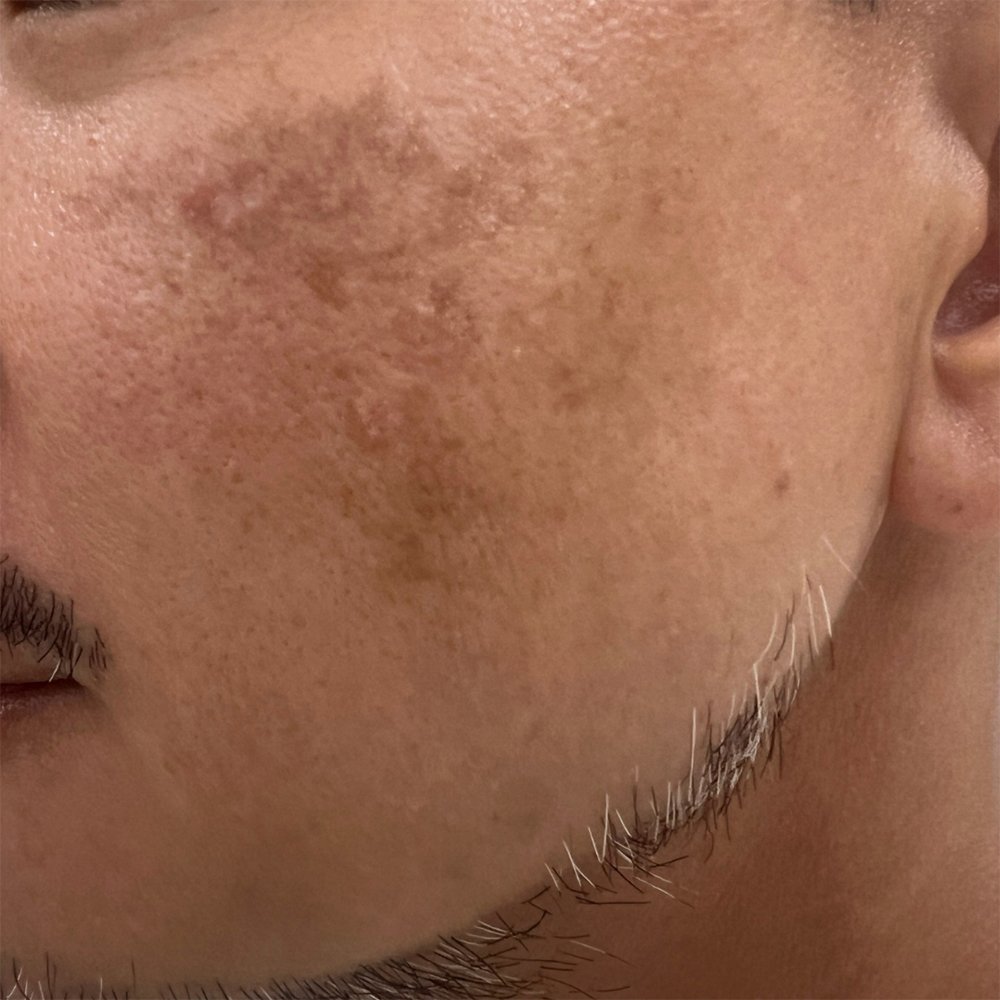 Before-Pigmentation