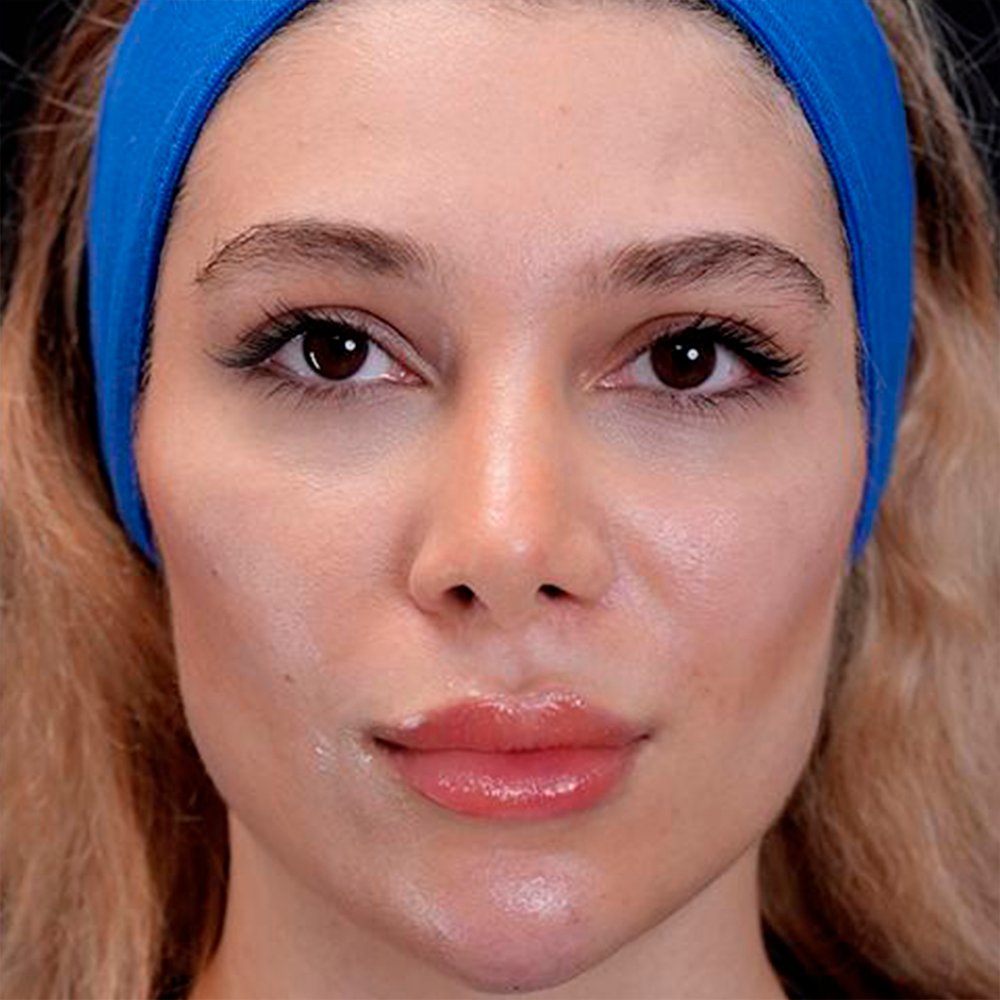 After-facefour