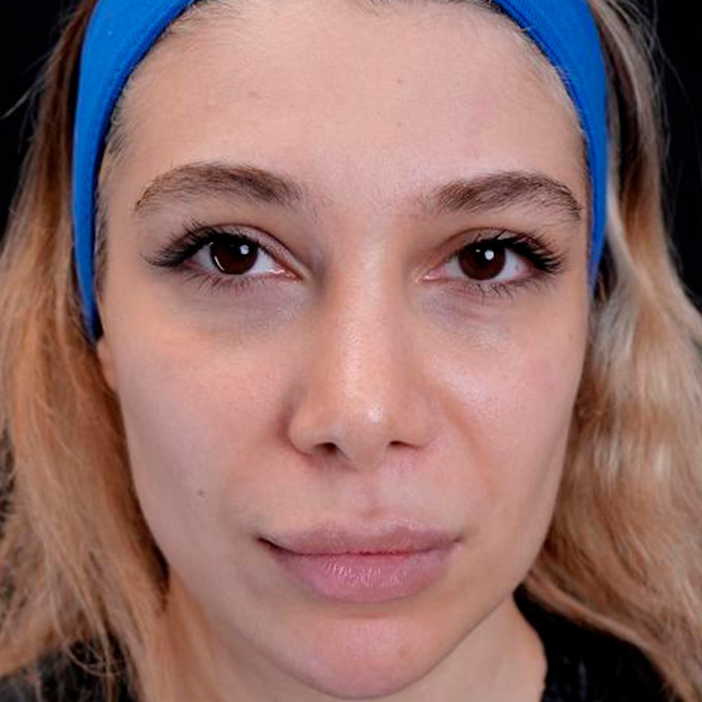 Before-facefour
