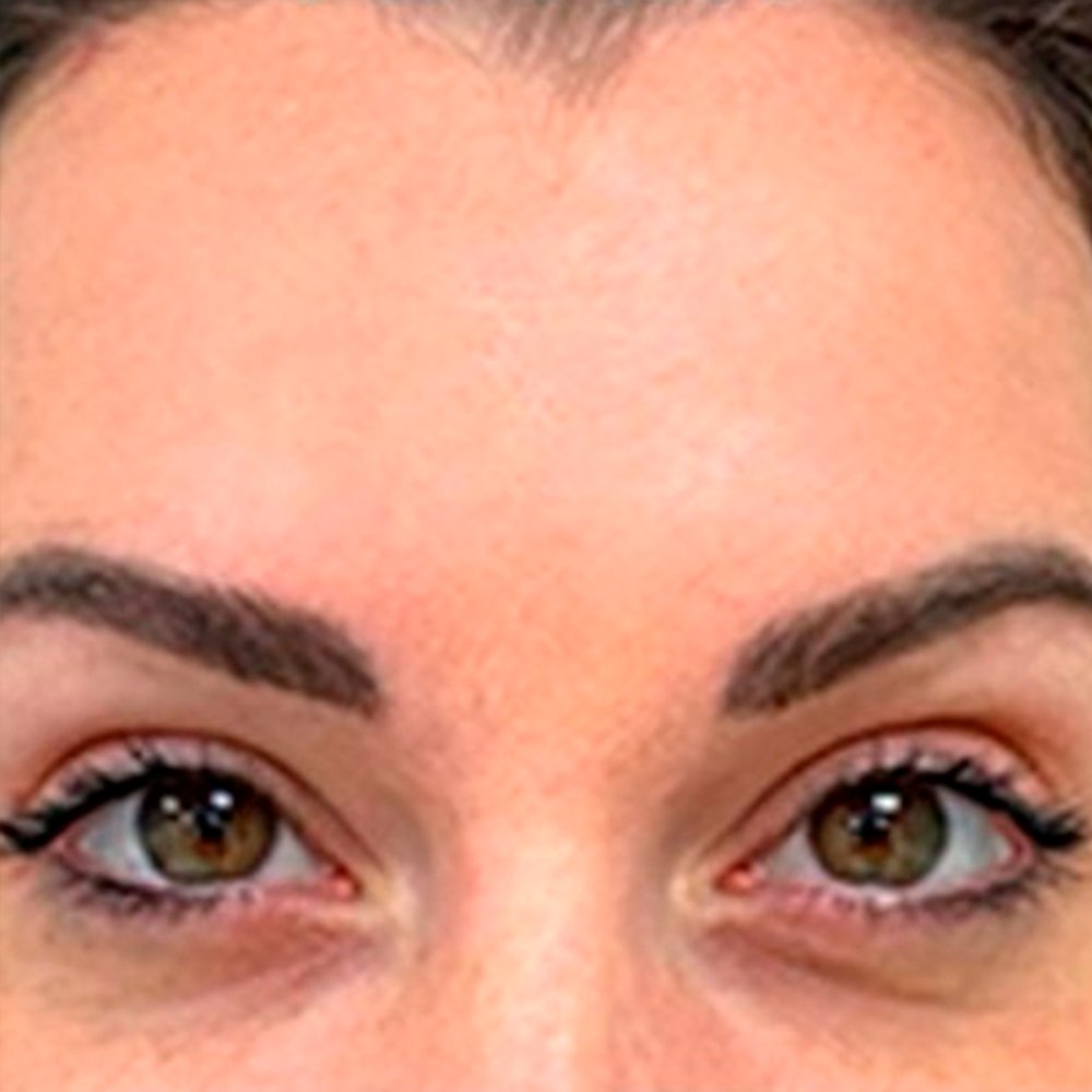 After-Botox