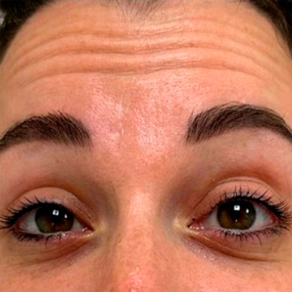 Before-Botox