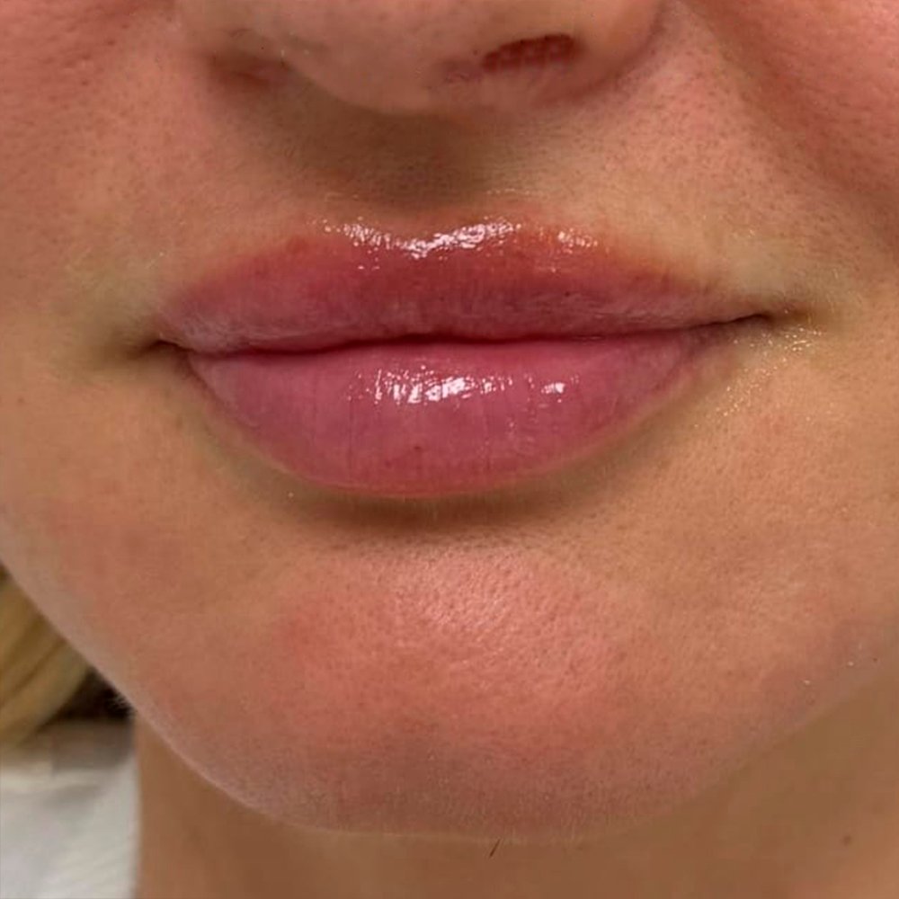 After-facelift