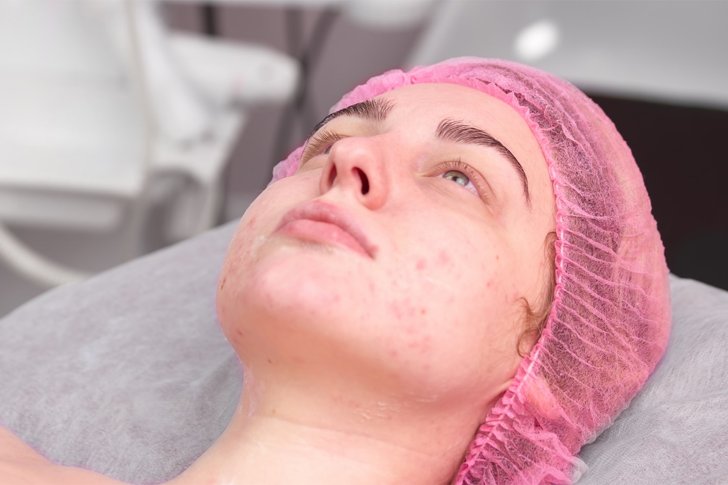 ACNE SCAR REMOVAL ACNE SCAR REMOVAL