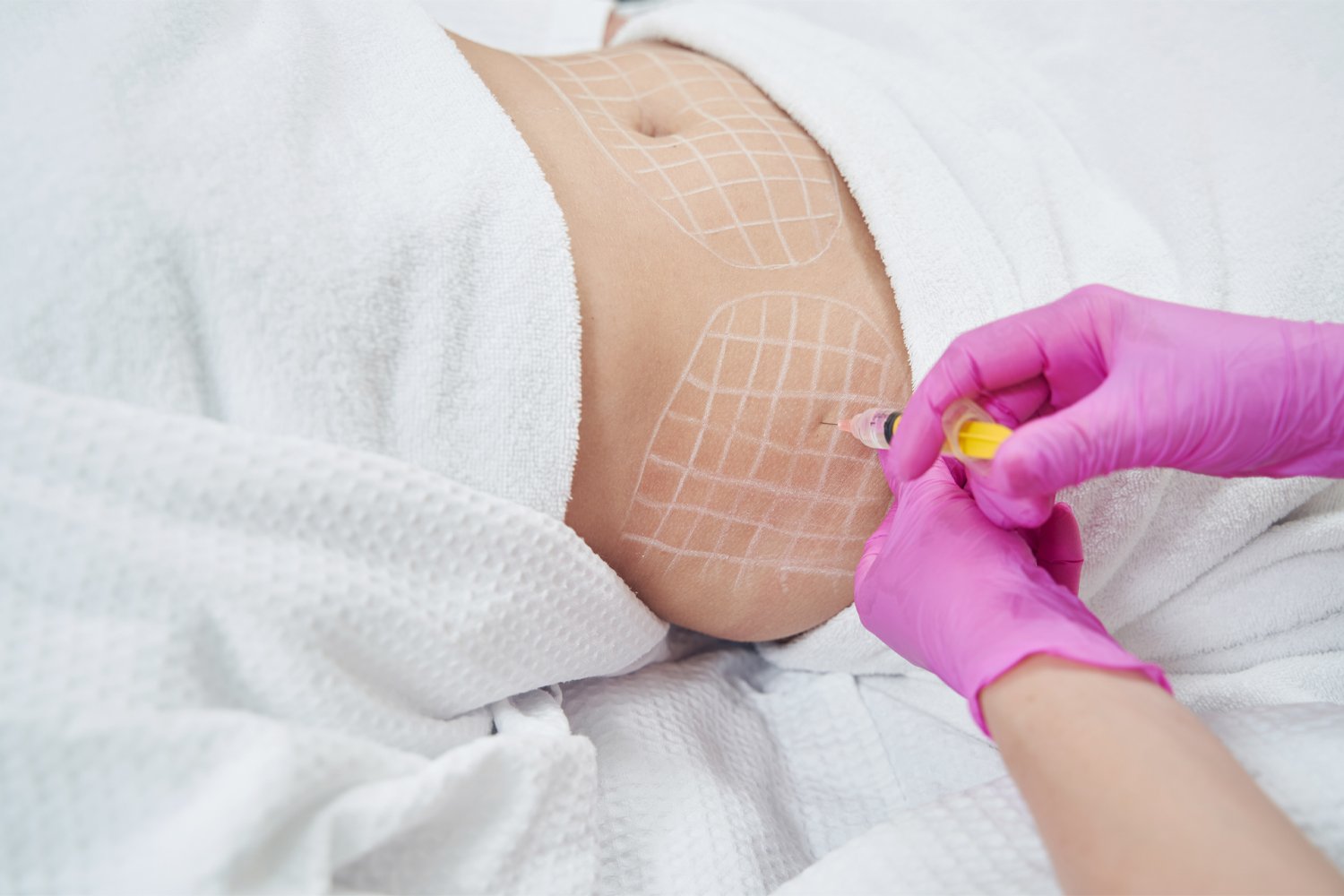 Mesotherapy for stretch marks
