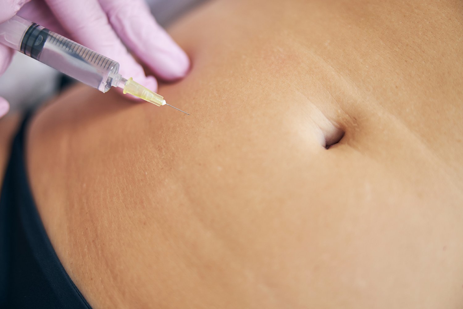 Stretch marks stem cells Stretch marks stem cells